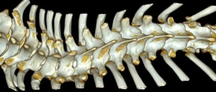 3d scoliosis dr lau leok lim spine scoliosis surgeon singapore