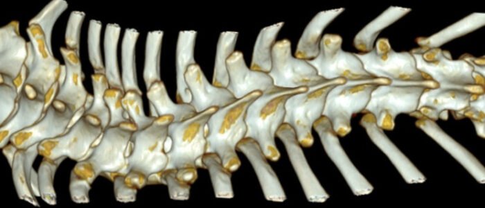 3d scoliosis dr lau leok lim spine scoliosis surgeon singapore