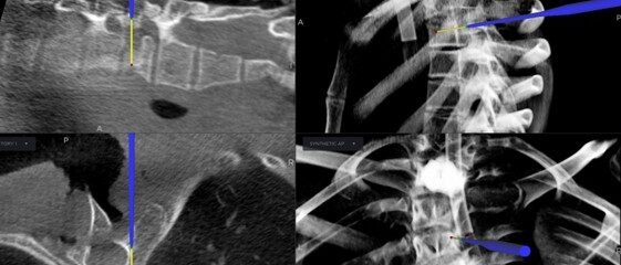 ct guided screw insertion Dr Lau Leok Lim Singapore Scoliosis Spine Surgeon