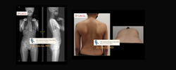 Keyhole endoscopic scoliosis correction illustration