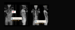 Posterior spinal fusion illustration