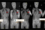 Unchecked progression of a scoliosis curve