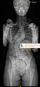 X-ray showing 70-degree scoliosis curve
