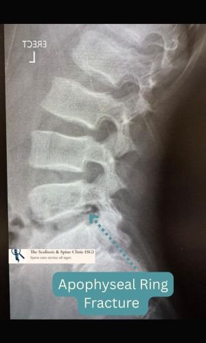 X-ray showing L5 apophyseal ring fracture