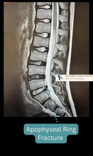 MRI showing apophyseal ring fracture without neural impingement