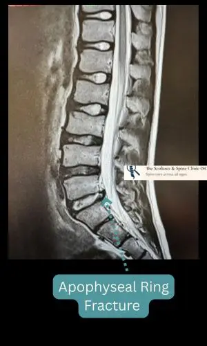 MRI showing apophyseal ring fracture without neural impingement
