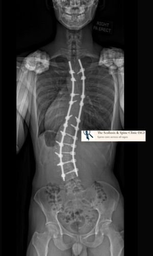 Lenke-6-curve-post-surgery-at-2-years-with-significant-correction