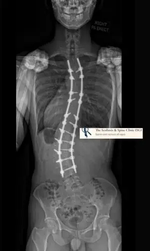 Lenke 6 curve postoperative correction