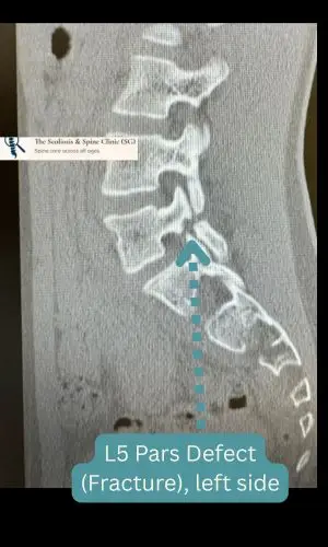 CT scan showing bilateral pars defect at L5
