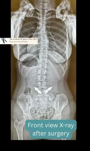 Post-op PA view showing alignment after pars repair