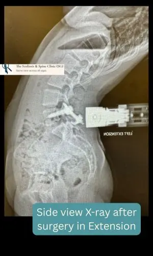 Post-op lateral view in extension showing healing
