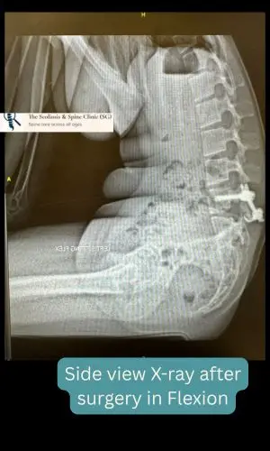 Post-op lateral view in flexion showing stability