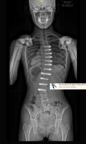1-year postoperative radiograph