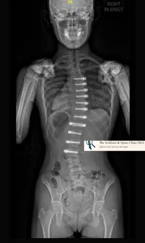 1-year postoperative radiograph