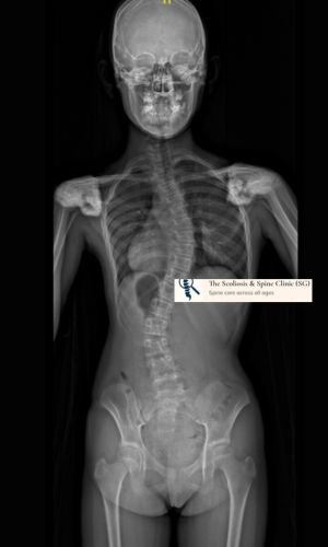 Preoperative radiograph