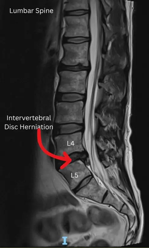 Lumbar disc herniation compressing spinal nerves