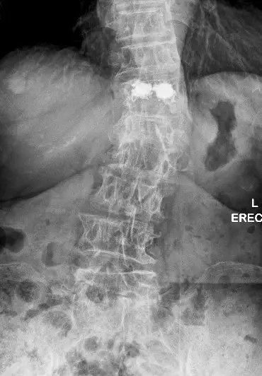 Appearance of the spine after vertebroplasty with cement-filled fractured vertebra
