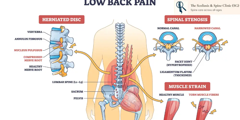 3 main causes of lower back pain