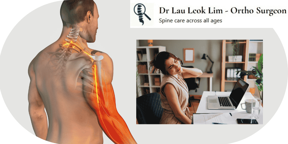 Cervical radiculopathy illustration