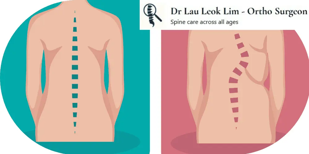 Scoliosis diagram