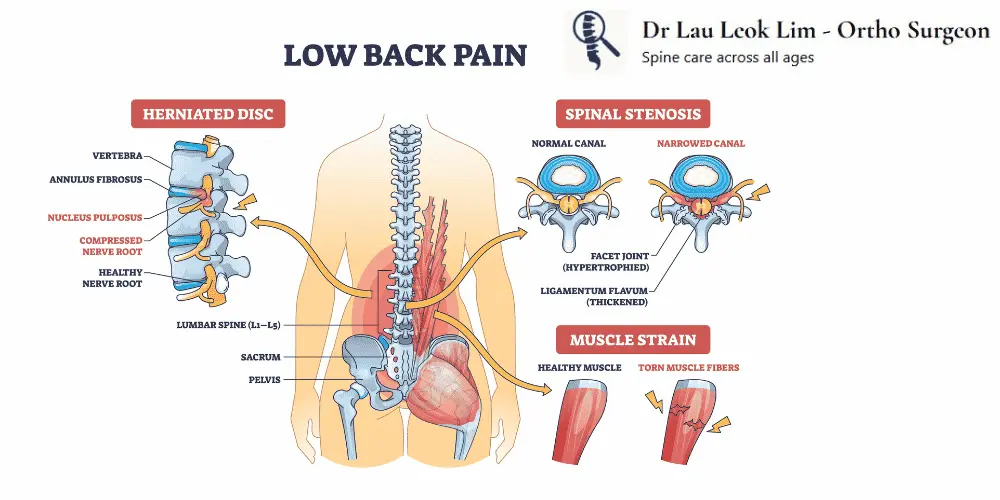 3 main causes of lower back pain