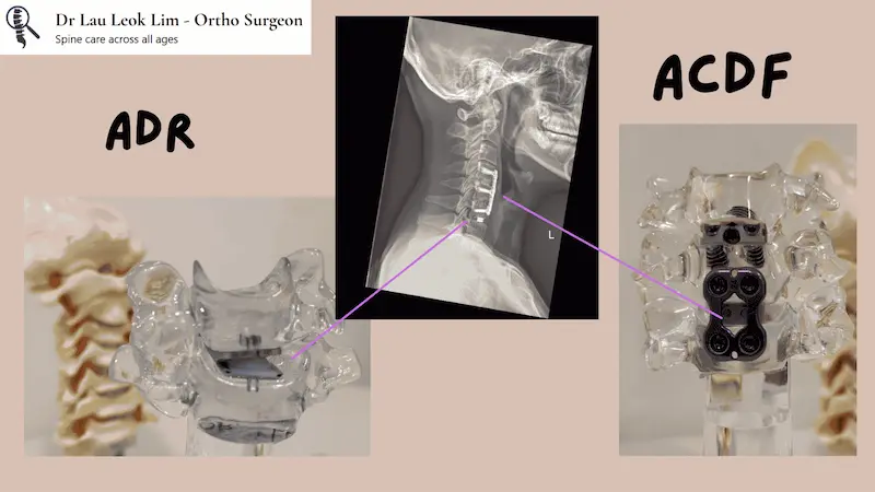 Comparison between ACDF and ADR procedures