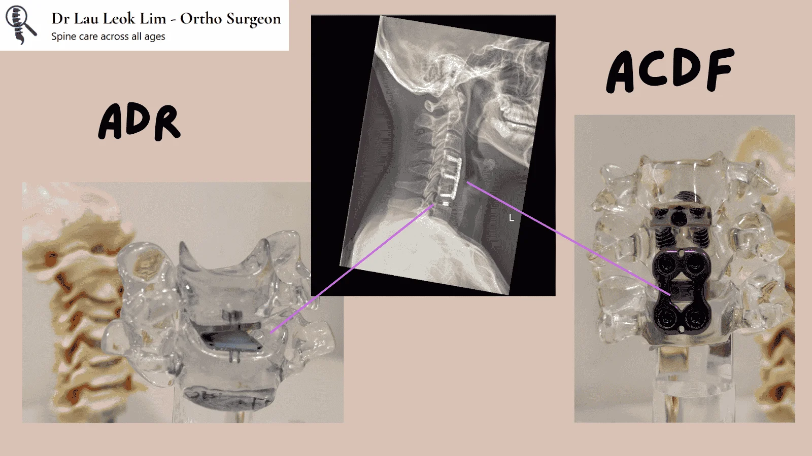 Comparison between ACDF and ADR procedures
