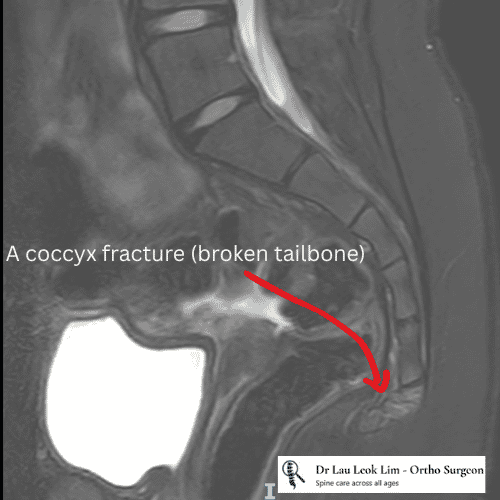 A coccyx fracture (broken tailbone)