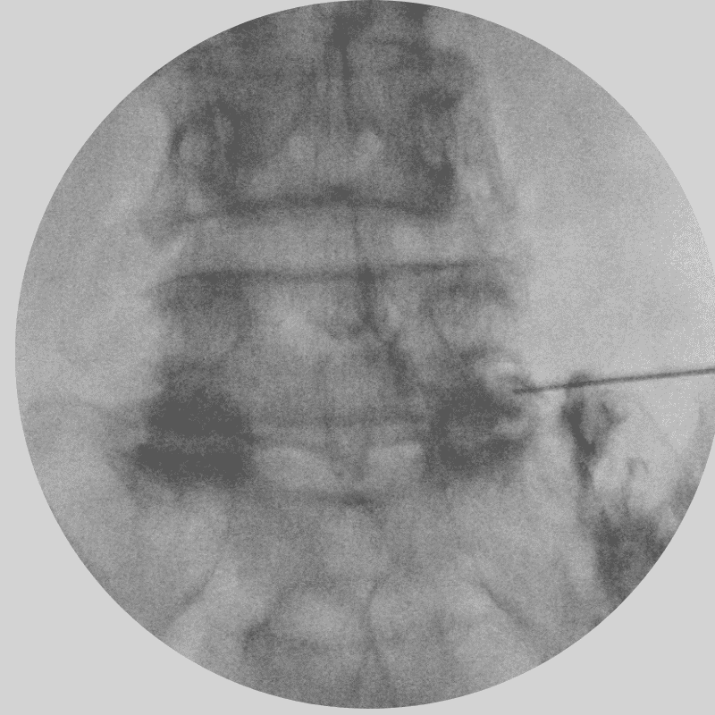 L5–S1 DRG Radiofrequency Stimulation