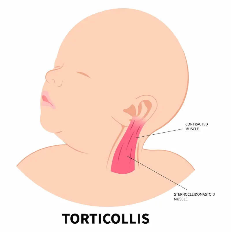 Muscular Torticollis illustration