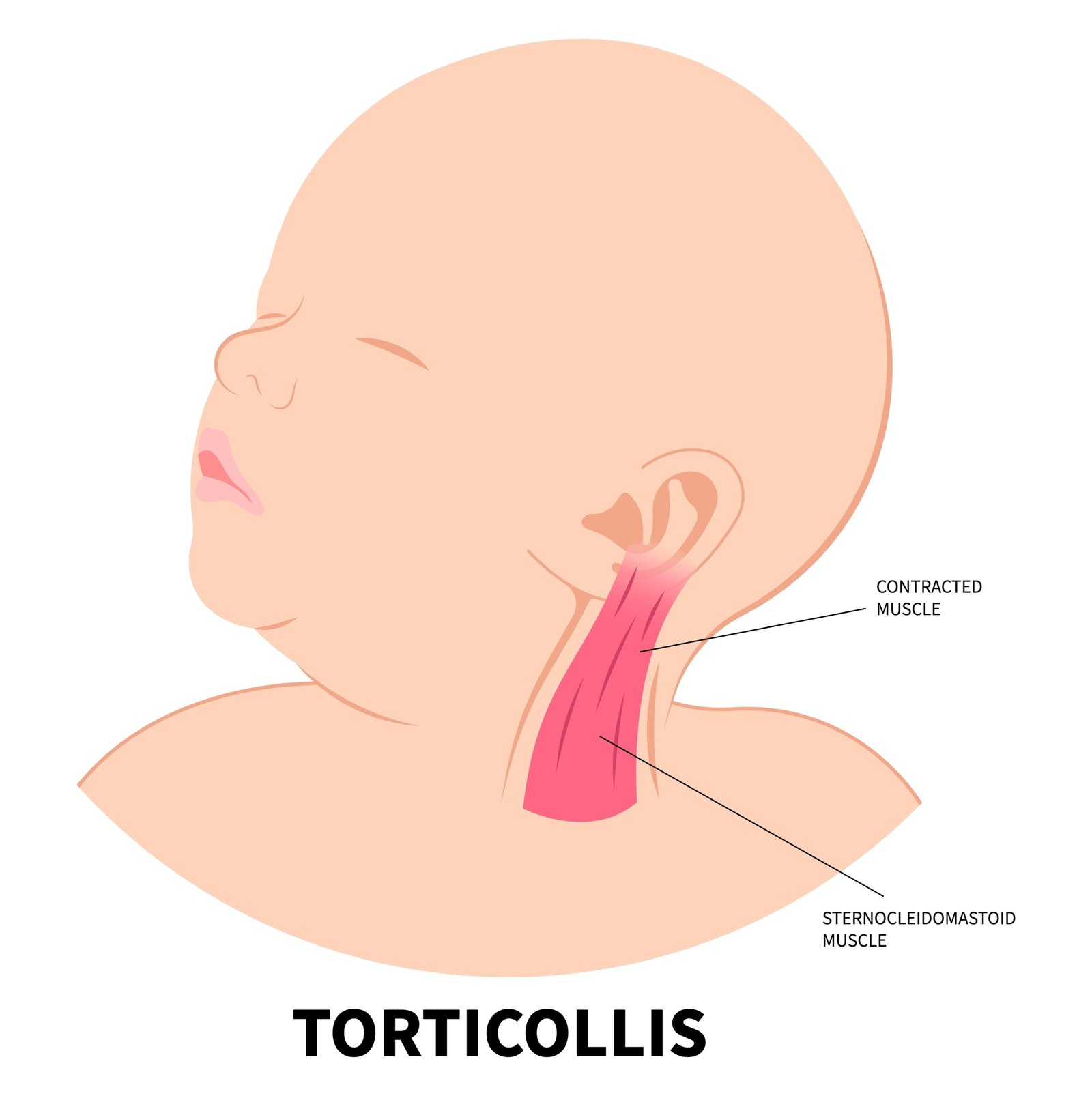 Muscular Torticollis illustration