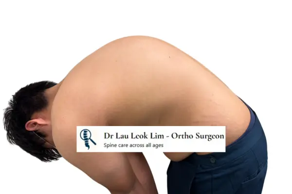 Scheuermann's kyphosis lateral view