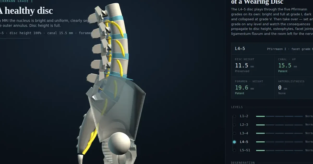 Interactive 3D illustration of degenerative disc disease: a healthy lumbar spine at Pfirrmann grade I, before the disc wears