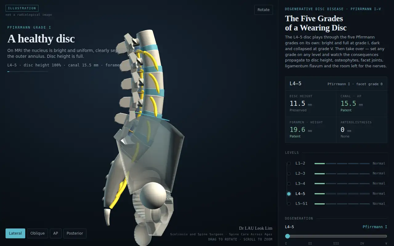 Opening frame of the interactive degenerative disc disease model: a healthy lumbar spine and pelvis at Pfirrmann grade I