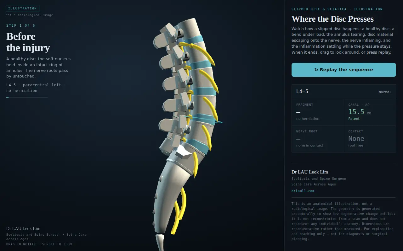 Opening frame of the interactive disc herniation model: a healthy lumbar spine before the injury