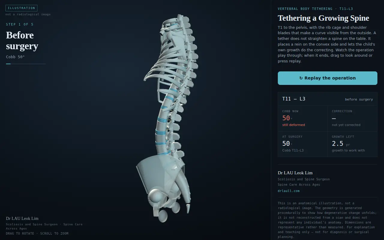 Opening frame of the interactive vertebral body tethering model: a growing spine with a 50-degree curve, rib cage and pelvis
