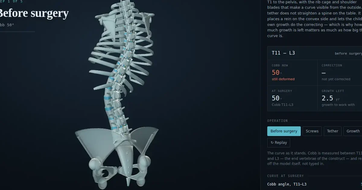 Interactive 3D illustration of vertebral body tethering for scoliosis, opening frame